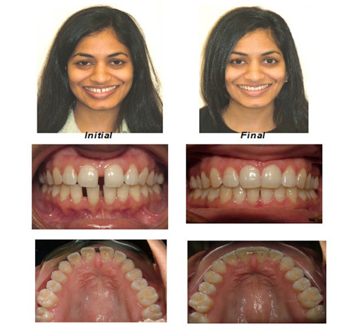 invisalign before and after crossbite