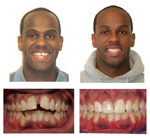 invisalign before and after spacing