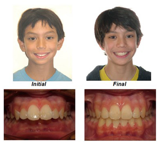 before and after braces overbite profile