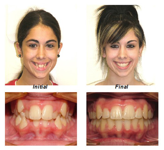Crowded Teeth-treated with non-extraction of teeth